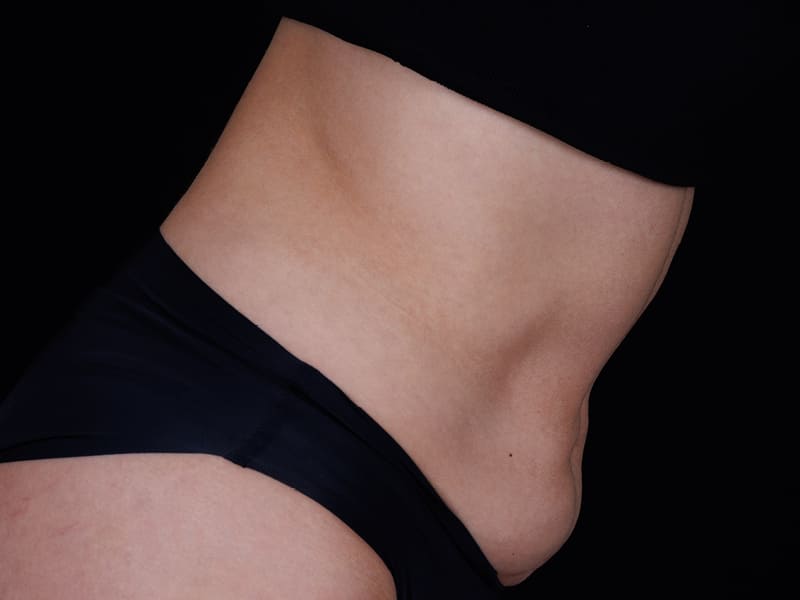 ULTHERAPY PRIME BAUCH SEITE NACHHER