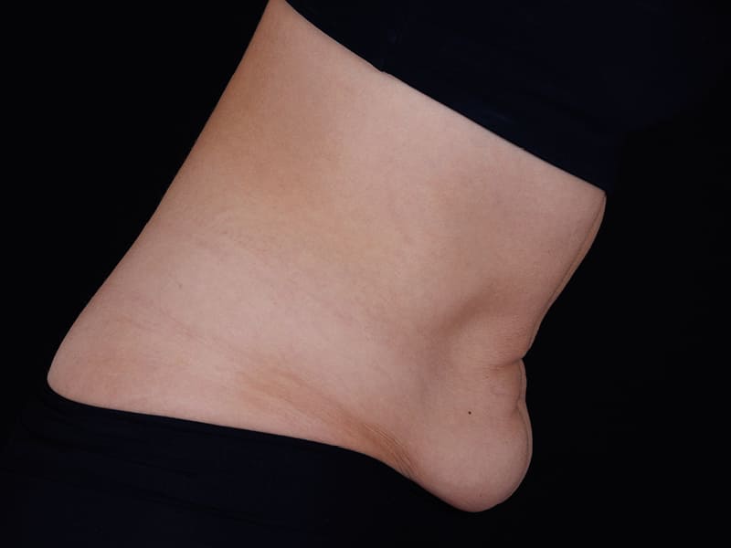 ULTHERAPY PRIME BAUCH SEITE VORHER
