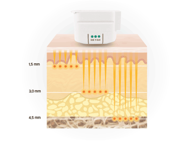 merz aesthetics ultherapy prime 04